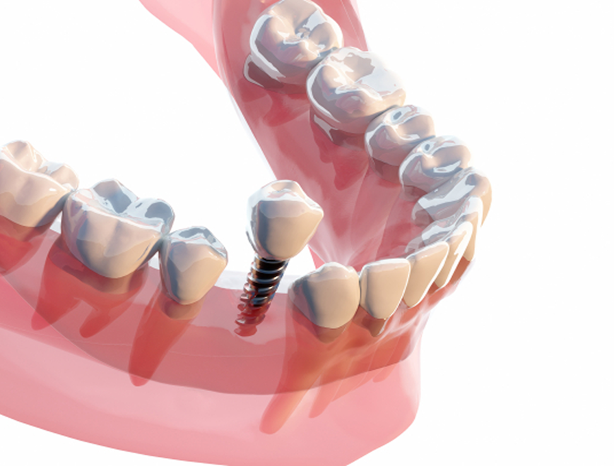 インプラントのイメージ